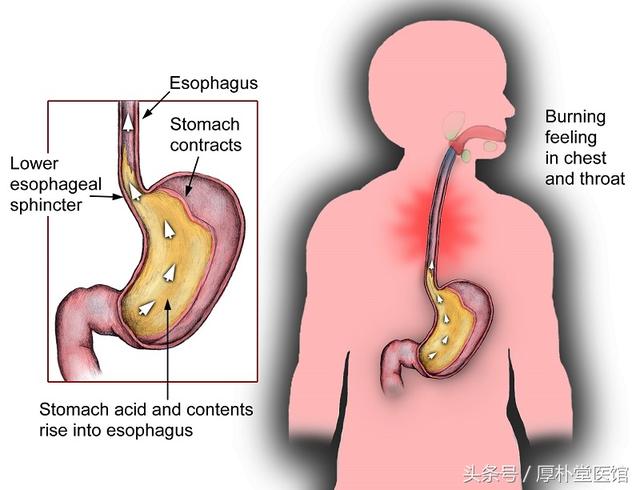 反流性食管炎怎么办