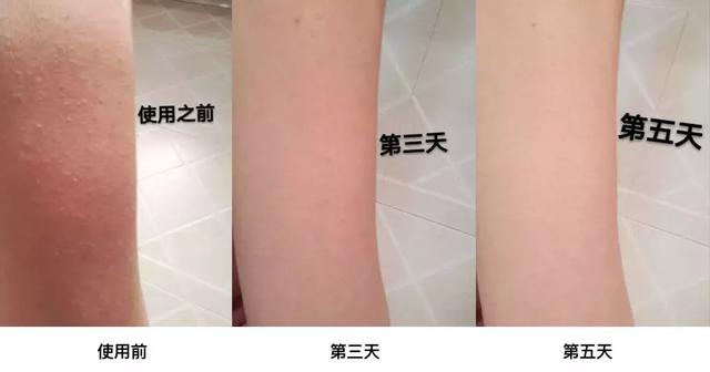 去鸡皮肤磨砂膏鸡皮疙瘩