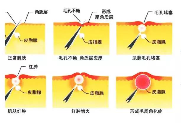 皮肤白有鸡皮怎么办