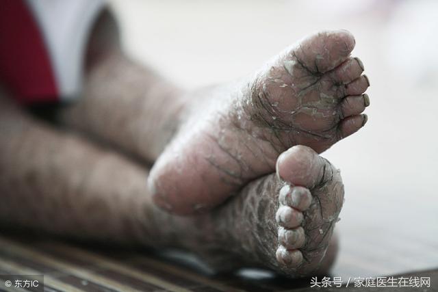 鱼鳞皮肤是如何引起的