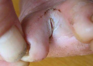 角化型湿疹口服点什么药