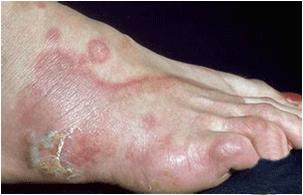 角化型湿疹口服点什么药