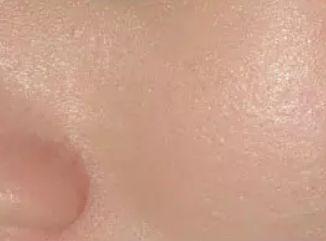 脸颊毛细血管扩张和毛周角化