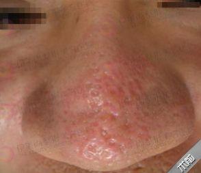 脸颊毛细血管扩张和毛周角化