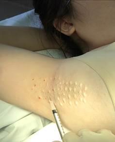 北京腋臭医院腋下出汗多有异味哈佛医学博士教教你三招去腋臭