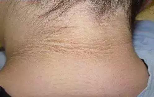 黑棘皮型脂溢性角化病