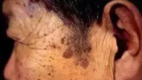 黑棘皮型脂溢性角化病