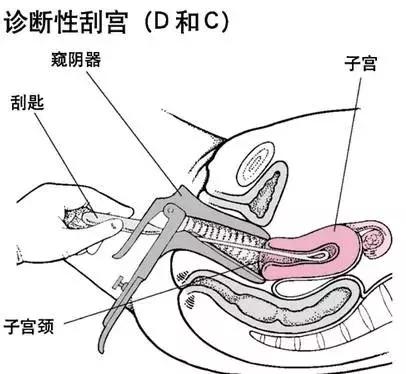 人流和刮宫是一回事吗