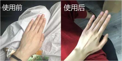 毛周角化病涂什么