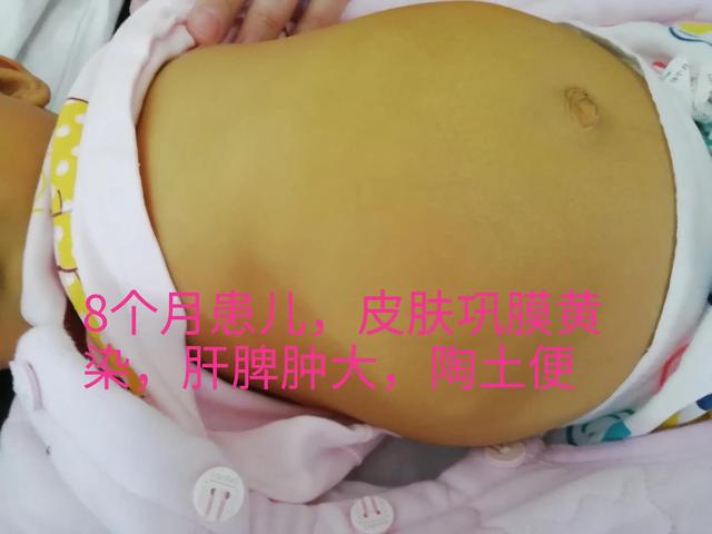 浅析幼儿黄疸之胆道闭锁的超声表现