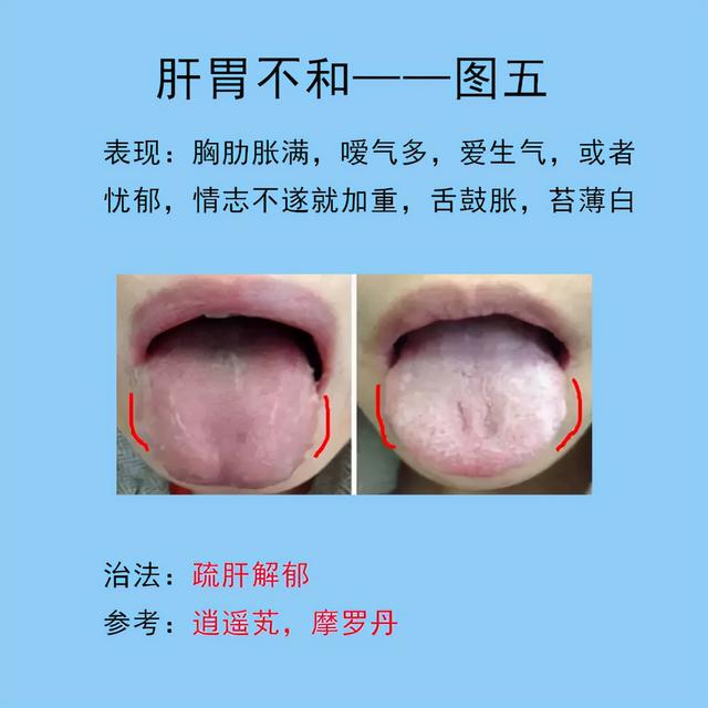 脾胃常见的10种舌象，以及临床表现，后面带解决方法