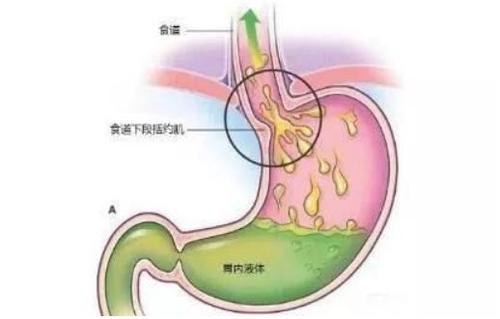 慢性胃炎吃多了就难受？可以试试多吃这2种食物