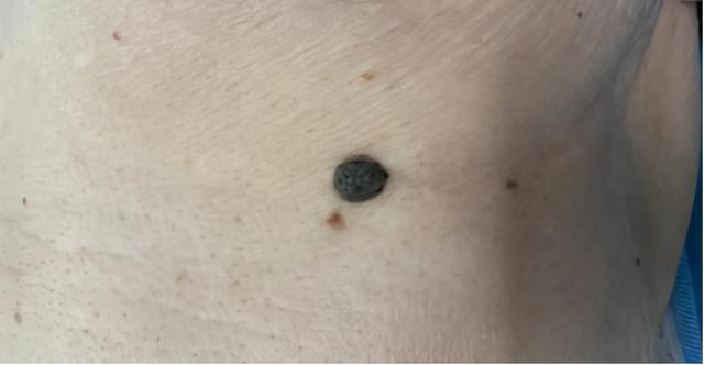 脂溢性角化病与肠胃癌