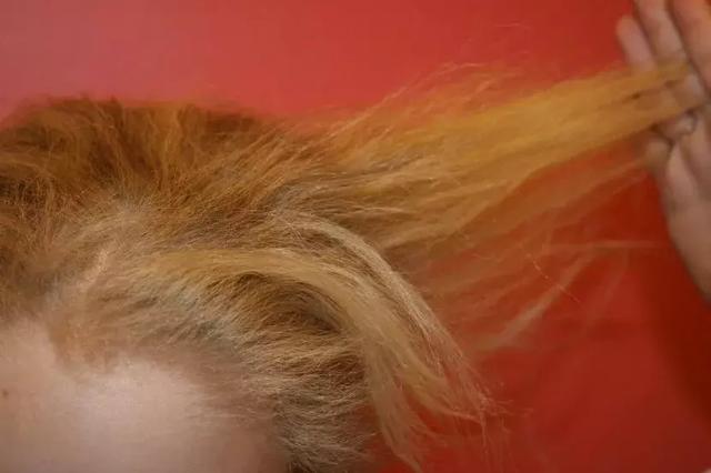 毛发卷曲角化不全