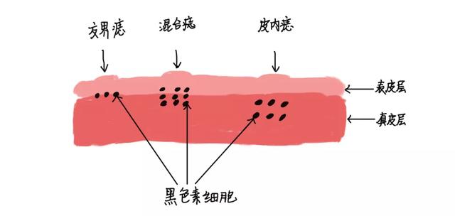 光动力做日光角化要几次
