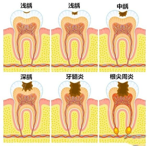 有了蛀牙怎么办