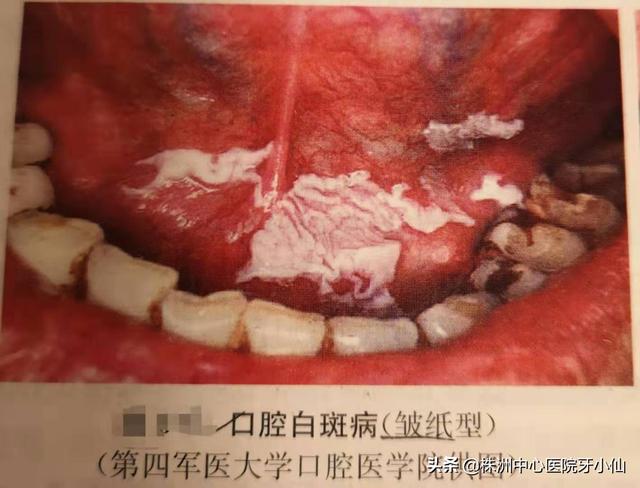 口腔颊白色角化吃什么