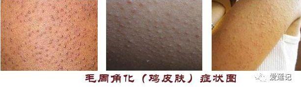 去腿上有鸡皮疙瘩的药