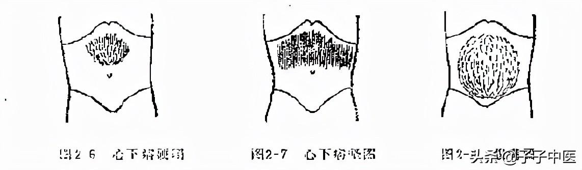 中医进阶学习 腹诊精华总结 太阳信息网