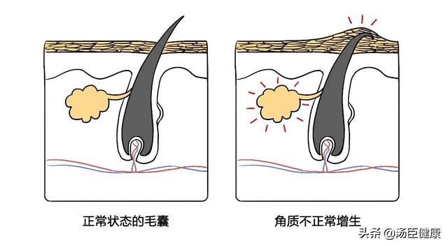 屁股有一块鸡皮疙瘩还痒