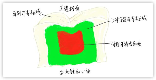 洁牙机