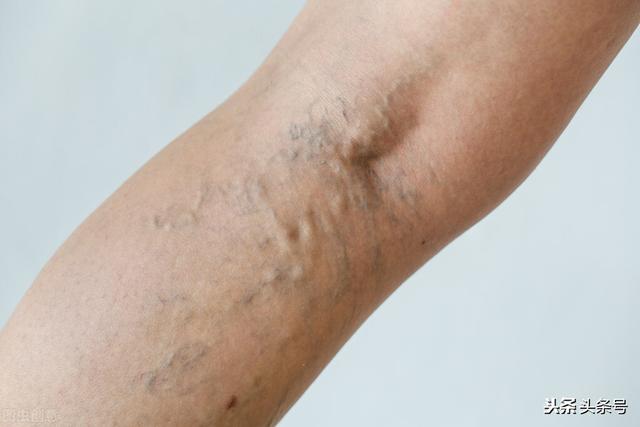 静脉曲张，老中医认为是脾虚，一张民间验方教你补气