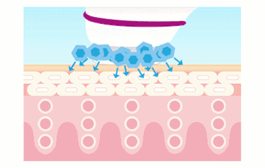 打完水光针毛周角化