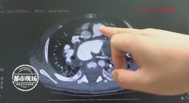 5月大婴儿心脏竟有成人般大小，医生：血管搭错了，很致命