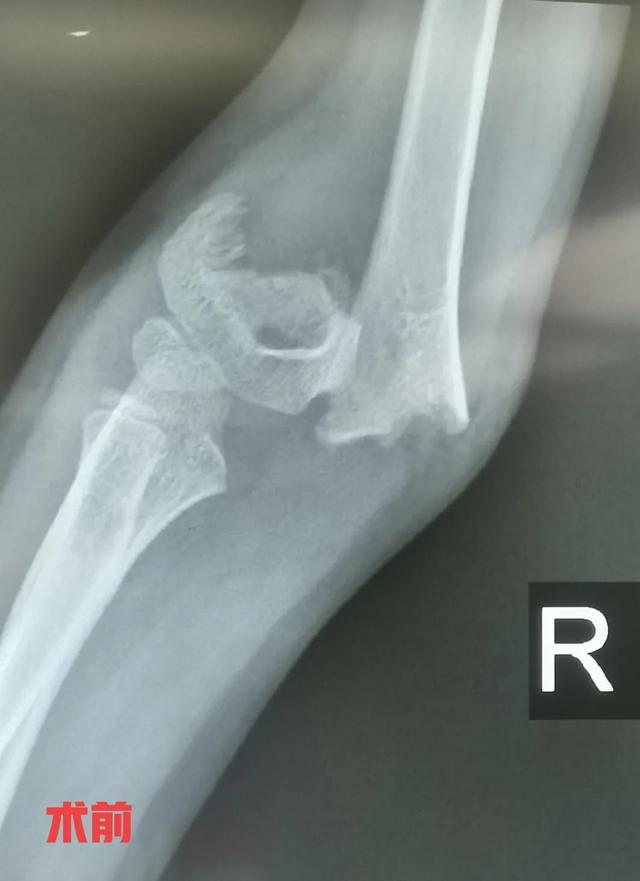 小儿肱骨髁上骨折小知识