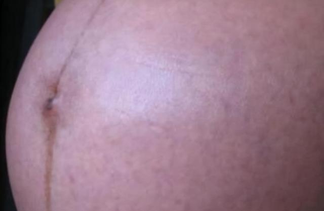 准妈妈孕肚上的“神秘”黑线，能预知胎宝性别？那可不一定