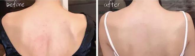 涂身体乳很痛怎么回事