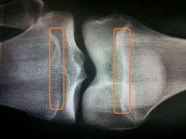 13岁男孩160cm，骨骺线快要闭合，提醒：出现2个特征前，抓紧补救