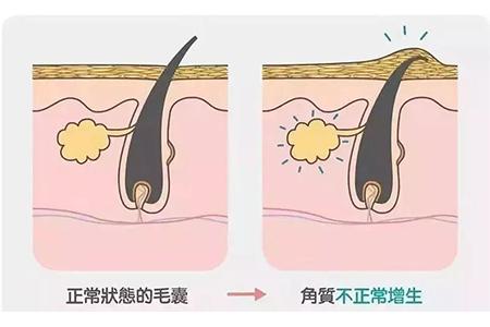 鸡皮肤药膏怎么用
