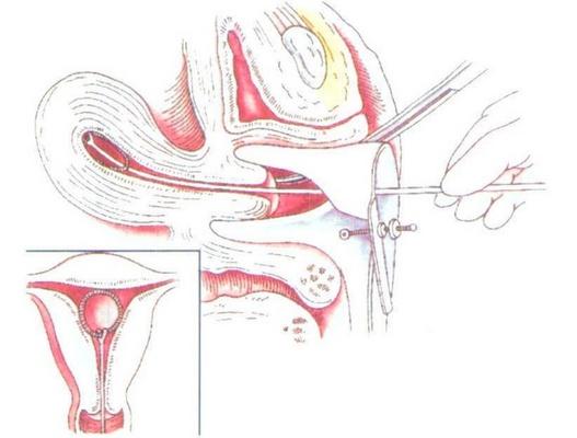 避孕环是什么原理（避孕环、节育环、宫内节育器是个啥）