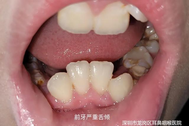 张口呼吸会长歪，用“闭嘴贴”？医生：胡来！