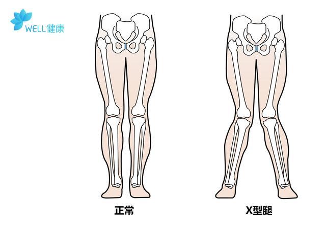 两岁宝宝八字腿严重