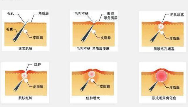 什么程度的鸡皮肤可以刷果酸