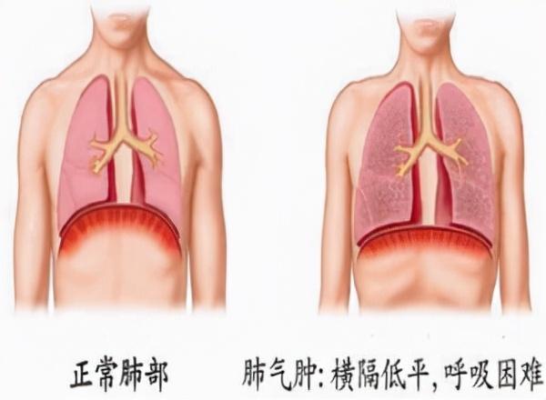 肺气肿患者应该注意哪些方面？