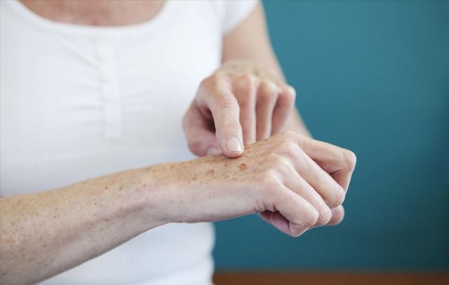 手点状角化与癌