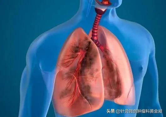 肺癌治疗，要从这五点入手