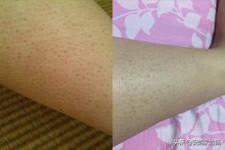 皮肤起鸡皮小疙瘩很痒