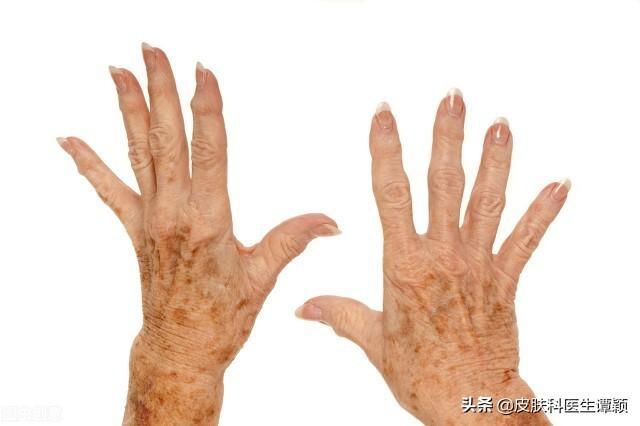 脂溢性角化手术费用