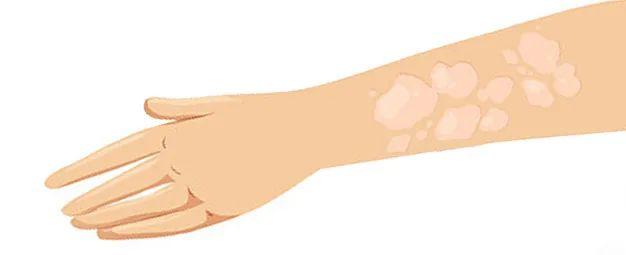 “多事之秋”谨防皮肤病侵扰