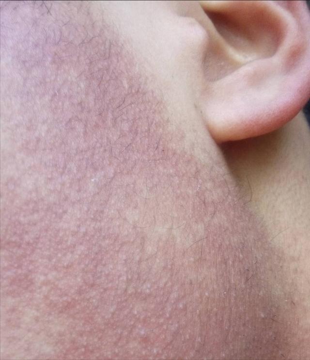 上半身鸡皮疙瘩瘙痒
