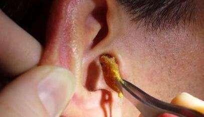 小孩身上皮肤像鸡皮疙瘩一样怎么回事啊