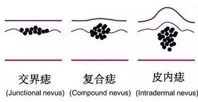 长痣怎么办