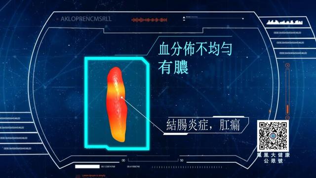 肠癌怎么办