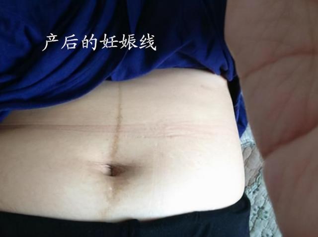 准妈妈孕肚上的“神秘”黑线，能预知胎宝性别？那可不一定