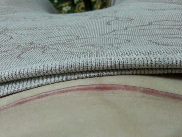 剖腹产刀口增生有什么影响？