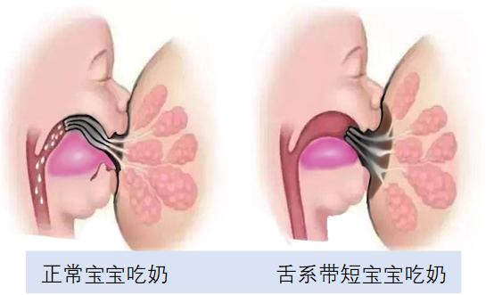 新生儿舌系带剪还是不剪？舌系带短有啥危害？